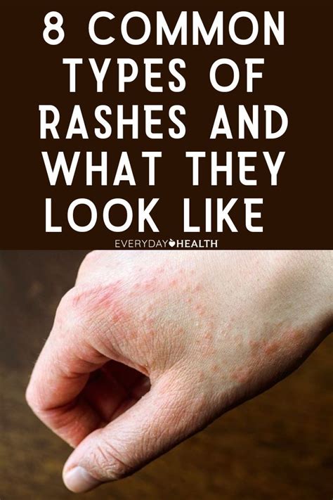 8 Common Types Of Rashes And What They Look Like Itchy Skin Rash