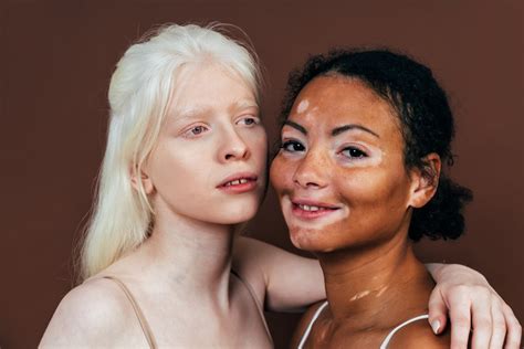 Here S How To Take Care Of Albinism Skin