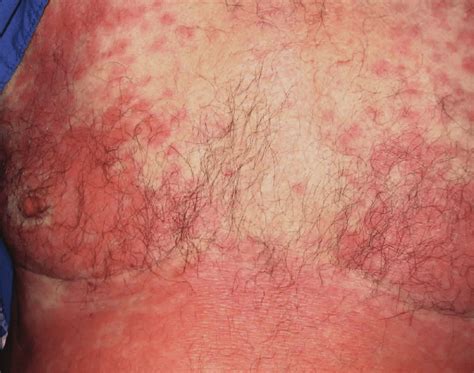 Erythematous Patchy Confluent Raised Skin Rash Over The Chest Download Scientific Diagram