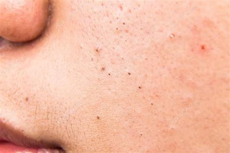 Pimple Blackheads On The Cheek Of A Teenager Stock Photo By ©thamkc