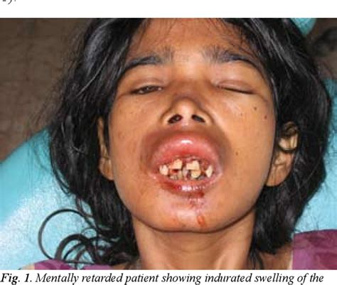 Figure 1 From Oral Myiasis In Mentally Challenged Patienta Case Report Semantic Scholar