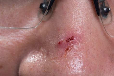 Basal Cell Carcinoma Bcc Treatment Us Dermatology Partners