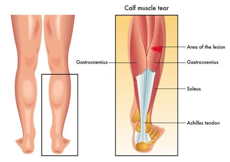 Calf Pain Physiotherapy Thrive Physio Plus