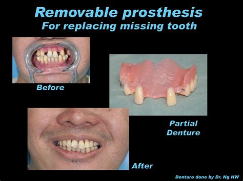 Flexible Denture Prestige Dental My