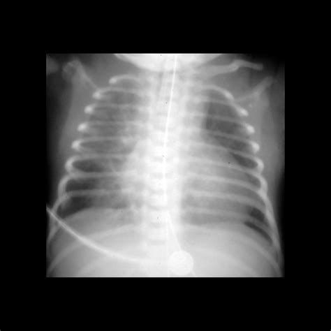 Hypoplastic Left Heart Syndrome Pediatric Radiology Reference Article