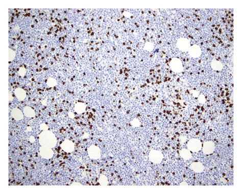 Case 1 Lymph Node Biopsy Showing Relapsed Splenic Marginal Zone