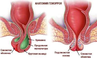 Internal hemorrhoids are comparatively much more manageable and usually have no symptoms. Female hemorrhoids photos, pictures of pregnancy ...