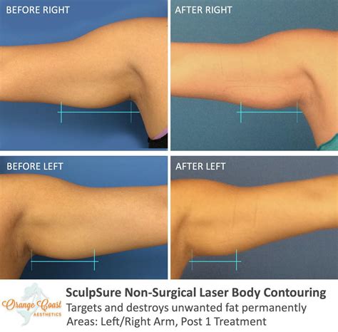 Sculpsure Before And After Photos Orange Coast Aesthetics