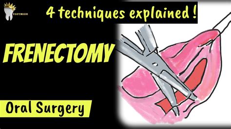 4 Techniques Of Frenectomy Surgery Why Is Frenum Removed Youtube