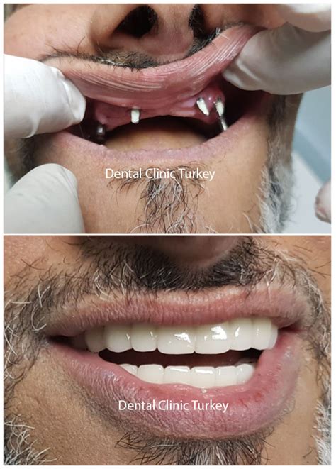Full Mouth Dental Implants Full Mouth Reconstruction Dental Clinic