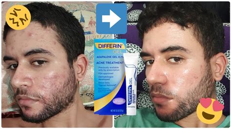 My 4 Months Acne Journey Using Differin Gel Before And After Youtube