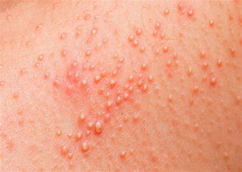 If the sweat glands become infected, antibiotics may be necessary. Heat Rash: All You Need to Know in 8 Photos | Heat rash ...