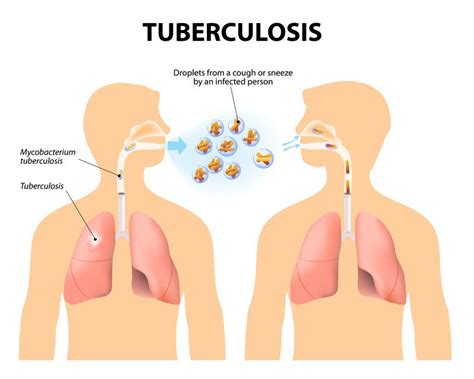 hoe gevaarlijk is tuberculose en hoe kan je het krijgen 7 vragen en