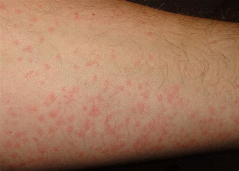 How To Treat Chronic Hives Extreme Natural Health News