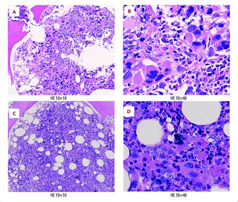 Bone Marrow Histology Showing Severe Fibrosis With Large And Clustering