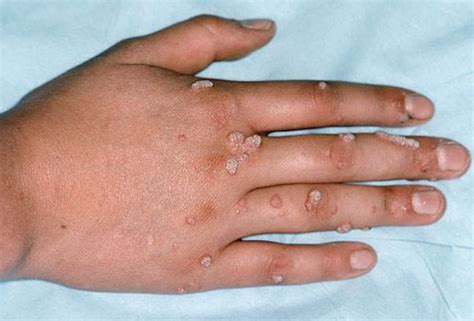 Warts Are Small Grainy Skin Growths That Occur Most Often On Your