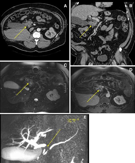 A B Computed Tomography Of The Pancreas Showing Residual Mild