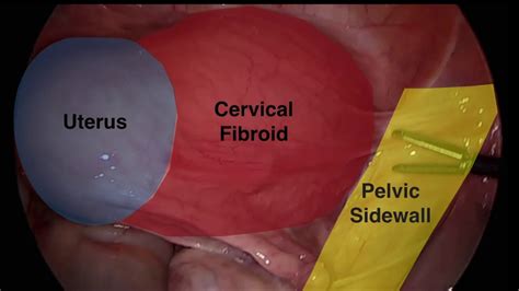Laparoscopic Hysterectomy For Cervical Fibroid Surgical Tips Youtube