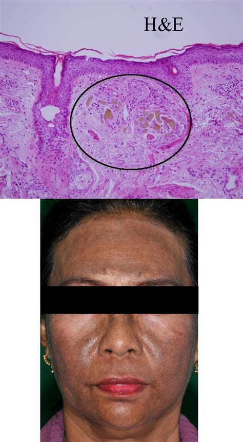 Figure 1 From Patch Testing And Histopathology In Thai Patients With