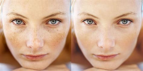 How To Prevent Freckles Skin We Are In