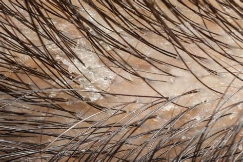 Scalp Buildup What Is It And How To Get Rid Of It