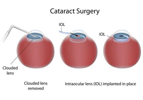 Femto Laser Cataract Surgery South Shore Eye Care