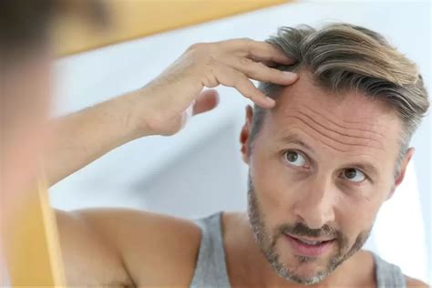 Male Pattern Baldness Causes Of Hair Loss Dr Bonaros