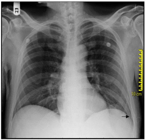 Initial Chest X Ray Fracture Of Left 8th 9th And 10th Open I