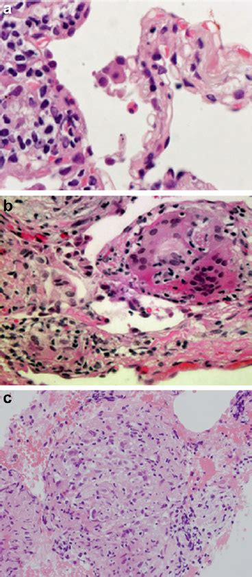 Pathological Fi Ndings Of A Transbronchial Lung Biopsy Specimen A And