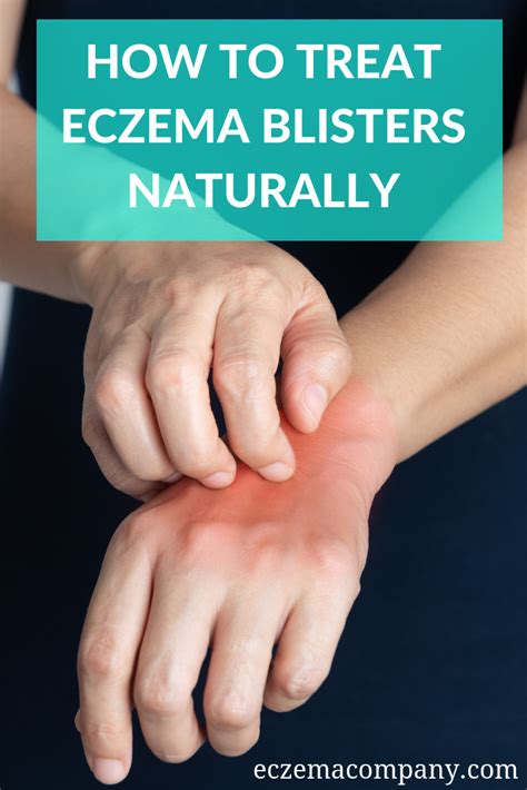 How To Treat Eczema Blisters Naturally How To Treat Eczema Blister