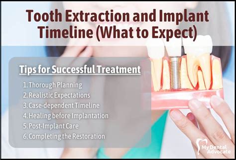 Tooth Extraction And Implant Timeline What To Expect Mda