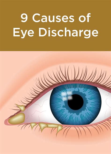 Pin On Eye Conditions