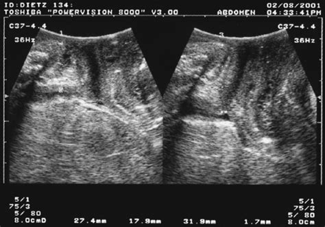 Pelvic Floor Ultrasound Abdominal Key