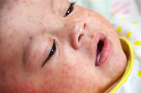 Measles Point Healthnz