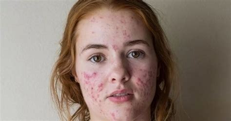 This Girls Extreme Acne Has Cleared Up Thanks To Magic Treatment