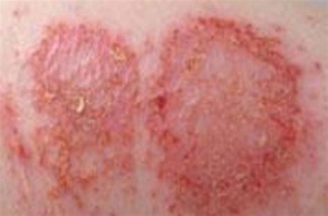 Discoidal Eczema