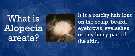 Homeopathy Treatment For Alopecia Areata Best Homeopathic Medicine