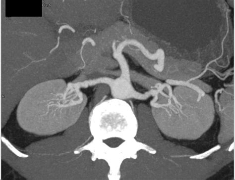 Fibromuscular Dysplasia Of The Renal Arteries Fmd Kidney Case