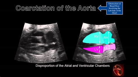 Fetal Echocardiography Coarctation Of The Aorta Youtube