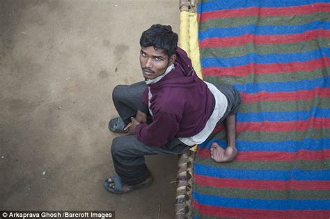 Indian Arun Kumar With Four Legs Pleads For Doctors To Remove The Extra