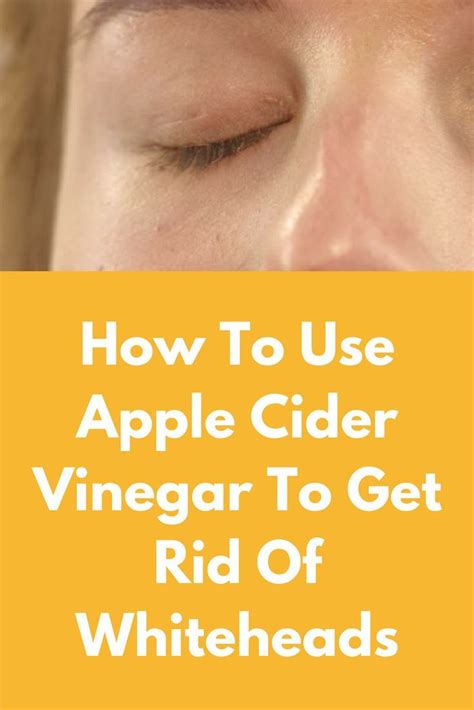 How To Use Apple Cider Vinegar To Get Rid Of Whiteheads Whiteheads