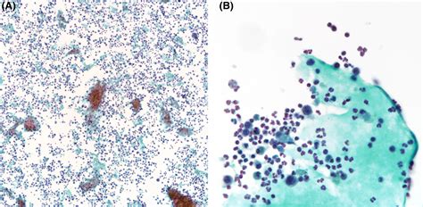 Aspiration Cytology Of Liver Abscess Uncovering Metastatic Rectal