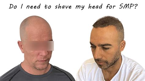 Do You Have To Shave Your Head For Scalp Micropigmentation