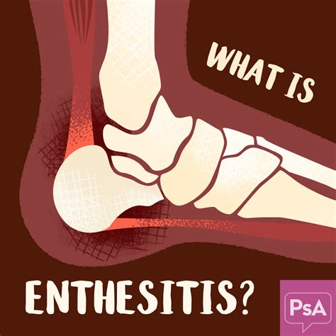 Enthesitis And Psoriatic Arthritis