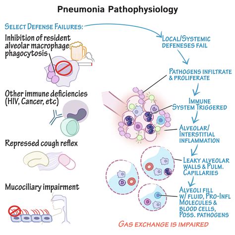 Immunologymicrobiology Glossary Pneumonia Draw It To Know It