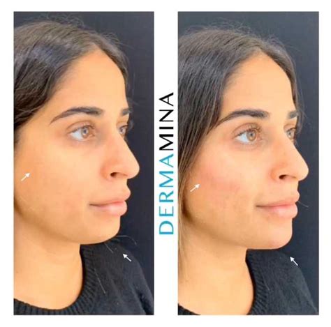 Dermal Filler Packages London · Dermamina