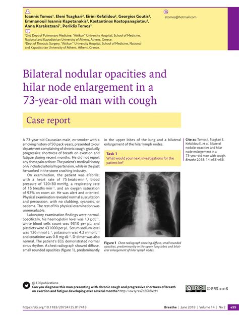 Pdf Bilateral Nodular Opacities And Hilar Node Enlargement In A 73