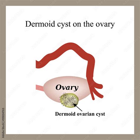 Dermoid Cyst On The Ovary Ovary Infographics Vector Illustration On