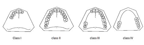 Kennedy Classification Rpd L Removable Partial Denture Mcqs Wikidentia