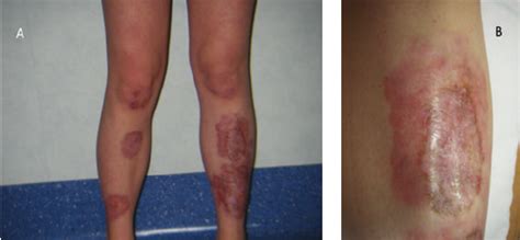 Skin Lesions Typically Appear On The Legs A Particular Of The Skin